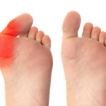 % Hallux valgus deformacija: Simptomai, priežastys, gydymas, prevencija