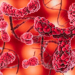 % Lėtinė mieloidinė leukemija: Simptomai, priežastys, gydymas, prevencija.