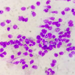 % Ūminė mieloidinė leukemija: Simptomai, priežastys, gydymas, prevencija