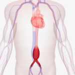 % Pilvo aortos aneurizma: Simptomai, priežastys, gydymas, prevencija