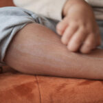 % Angioneurozinė edema: simptomai, priežastys, gydymas, prevencija