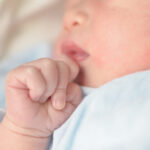 % Impetiga: simptomai, priežastys, gydymas, prevencija