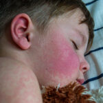 % Tymai: Simptomai, priežastys, gydymas, prevencija