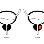 % Varpos vėžys: Simptomai, priežastys, gydymas, prevencija