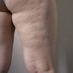 % Lipedema: Gydymas, simptomai, priežastys, prevencija