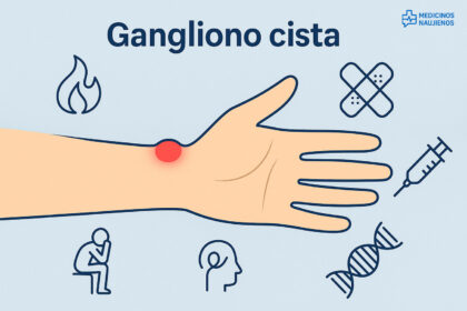 % Gangliono cista: simptomai, priežastys, gydymas, prevencija