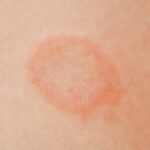 % Žieduotoji pūslelinė ir kitos grybelinės infekcijos: Simptomai, priežastys, gydymas, prevencija