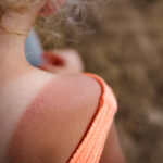 % Nudegimas saulėje: Simptomai, priežastys, gydymas, prevencija