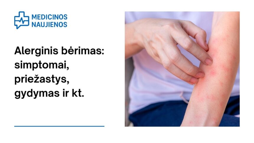 % Alerginis bėrimas: simptomai, priežastys, gydymas ir kt.