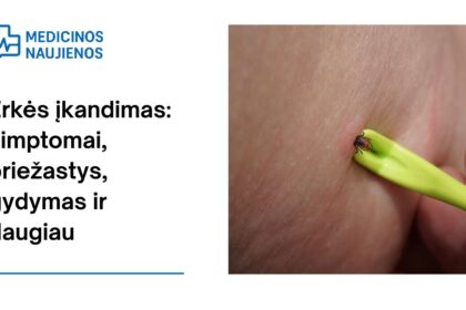 % Erkės įkandimas: simptomai, priežastys, gydymas ir daugiau