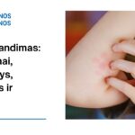 % Blusų įkandimas: simptomai, priežastys, gydymas ir daugiau