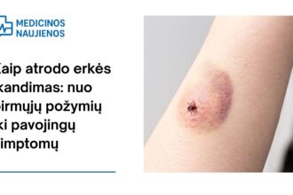 % Kaip atrodo erkės įkandimas: nuo pirmųjų požymių iki pavojingų simptomų