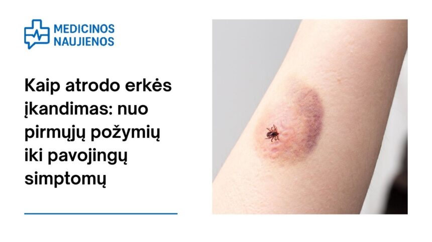 % Kaip atrodo erkės įkandimas: nuo pirmųjų požymių iki pavojingų simptomų