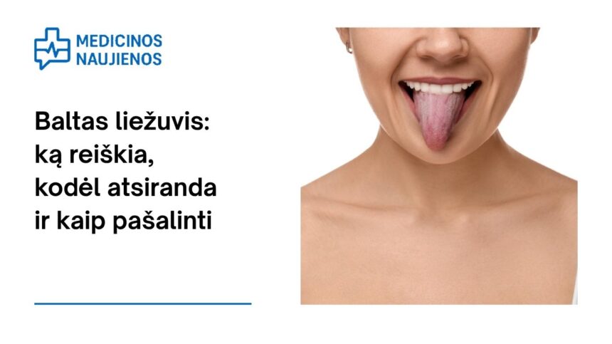 % Baltas liežuvis: ką reiškia, kodėl atsiranda ir kaip pašalinti