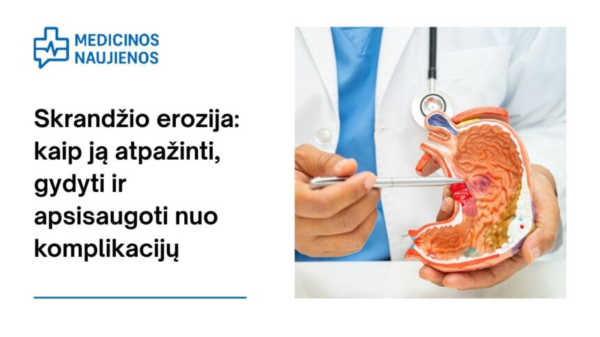 % Skrandžio erozija: kaip ją atpažinti, gydyti ir apsisaugoti nuo komplikacijų