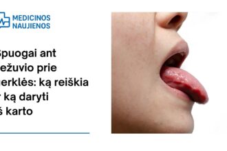 % Spuogai ant liežuvio prie gerklės: ką reiškia ir ką daryti iš karto