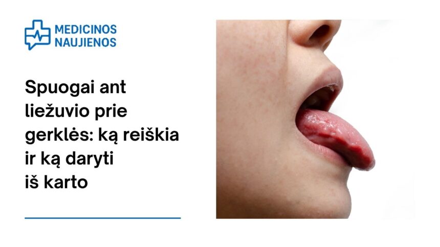 % Spuogai ant liežuvio prie gerklės: ką reiškia ir ką daryti iš karto
