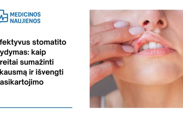% Efektyvus stomatito gydymas: kaip greitai sumažinti skausmą ir išvengti pasikartojimo