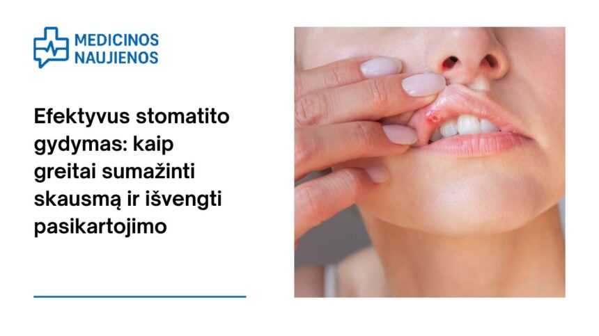 % Efektyvus stomatito gydymas: kaip greitai sumažinti skausmą ir išvengti pasikartojimo