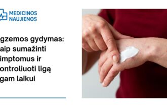 % Egzemos gydymas: kaip sumažinti simptomus ir kontroliuoti ligą ilgam laikui