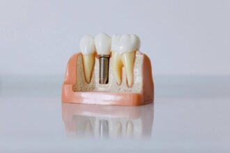 % Vienmomentė implantacija: Ar tai geriausias sprendimas prarastiems dantims?