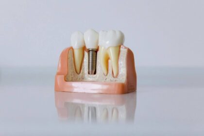% Vienmomentė implantacija: Ar tai geriausias sprendimas prarastiems dantims?