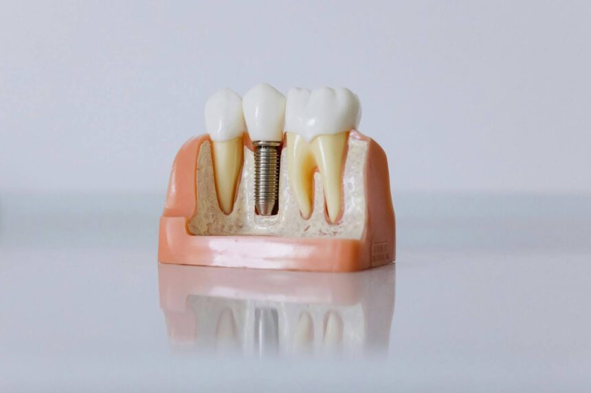 % Vienmomentė implantacija: Ar tai geriausias sprendimas prarastiems dantims?
